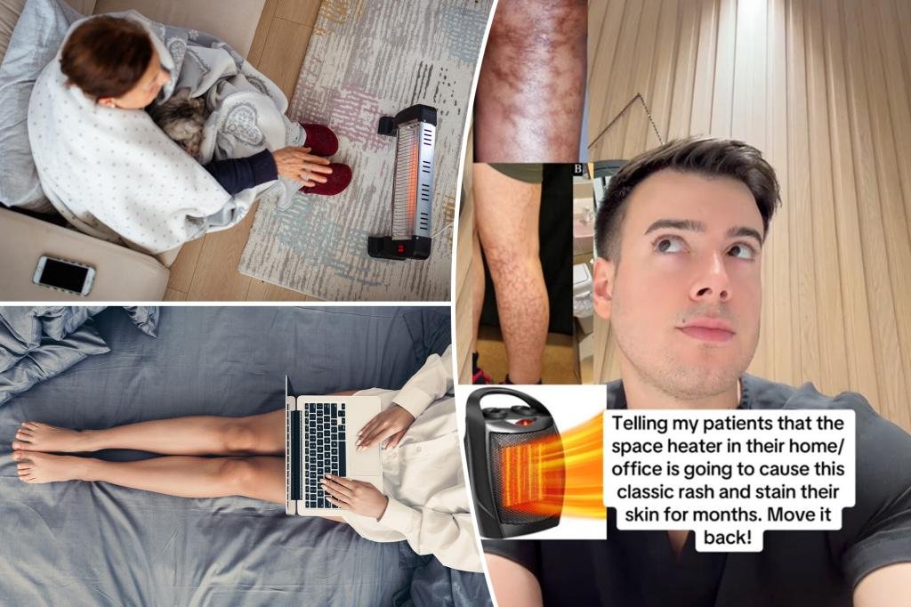 Leia mais sobre o artigo Space heater can cause erythema ab igne, doctor warns