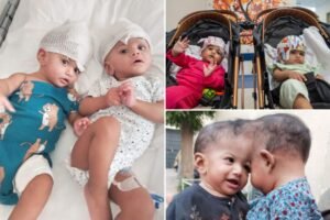 Leia mais sobre o artigo Conjoined twins born with conjoined brain tissue were separated after a risky operation